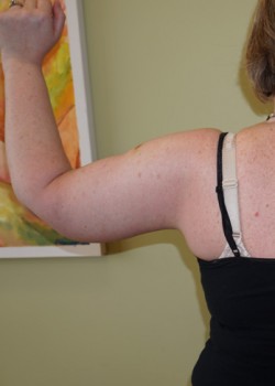 After Image: Arm Lift - back