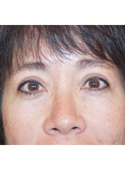 After Image: Asian Double Eyelid - front