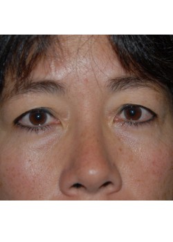 Before Image: Asian Double Eyelid - front