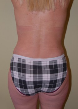 After Image: Liposuction Love Handles - back