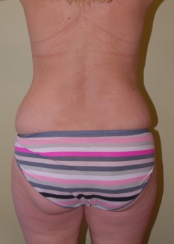 Before Image: Liposuction Love Handles - back