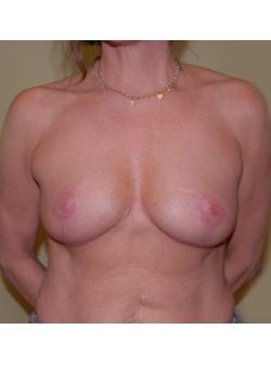 After Image: Breast Reduction - front