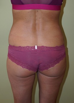 Before Image: Liposuction Love Handles - back