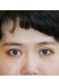 After Image: Asian Double Eyelid - front