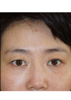 Before Image: Asian Double Eyelid - front