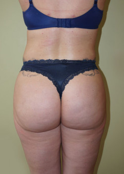 After Image: Brazilian Butt Lift - front