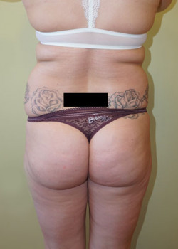 Before Image: Brazilian Butt Lift - front