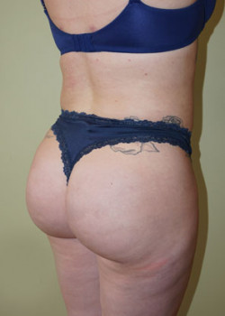 After Image: Brazilian Butt Lift - right-front-oblique