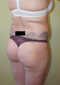 Before Image: Brazilian Butt Lift - right-front-oblique