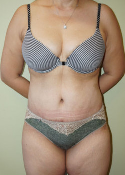After Image: Tummy Tuck, Liposuction - front