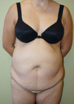 Before Image: Tummy Tuck, Liposuction - front