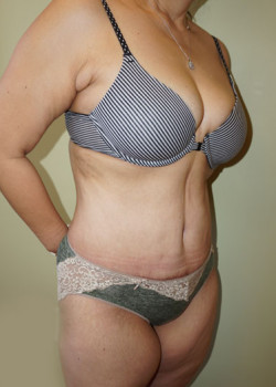 After Image: Tummy Tuck, Liposuction - right-front-oblique