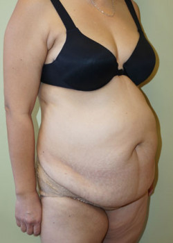 Before Image: Tummy Tuck, Liposuction - right-front-oblique