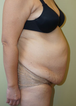 Before Image: Tummy Tuck, Liposuction - other