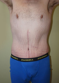 After Image: Extended Tummy Tuck - front
