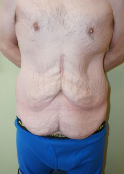 Before Image: Extended Tummy Tuck - front