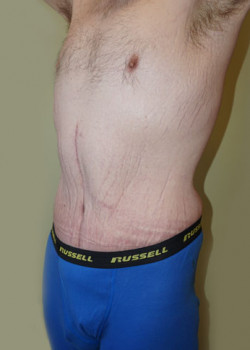 After Image: Extended Tummy Tuck - left-front-oblique