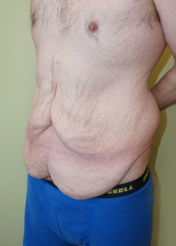 Before Image: Extended Tummy Tuck - left-front-oblique