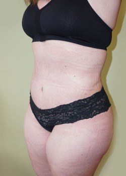After Image: Tummy Tuck, Liposuction - left-front-oblique