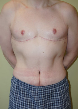 After Image: Tummy Tuck, Liposuction - front
