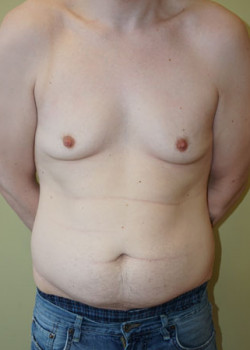Before Image: Tummy Tuck, Liposuction - front