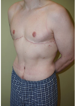 After Image: Tummy Tuck, Liposuction - left-front-oblique