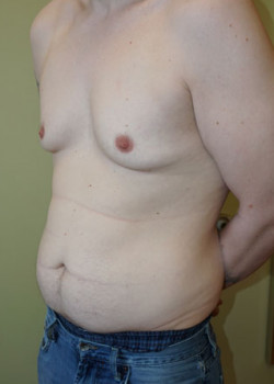 Before Image: Tummy Tuck, Liposuction - left-front-oblique