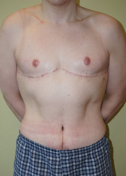 After Image: Breast Reduction - front