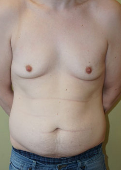 Before Image: Breast Reduction - front