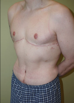 After Image: Breast Reduction - left-front-oblique