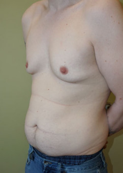 Before Image: Breast Reduction - left-front-oblique