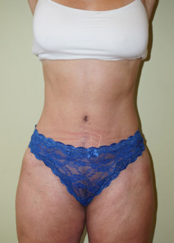 After Image: Tummy Tuck, Liposuction - front