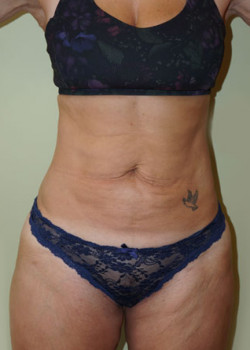 Before Image: Tummy Tuck, Liposuction - front