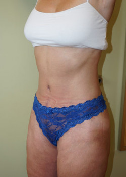 After Image: Tummy Tuck, Liposuction - left-front-oblique