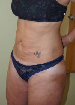 Before Image: Tummy Tuck, Liposuction - left-front-oblique