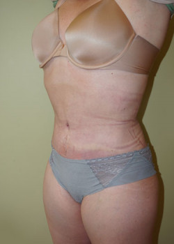 After Image: Tummy Tuck, Liposuction - left-front-oblique