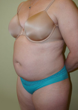 Before Image: Tummy Tuck, Liposuction - left-front-oblique
