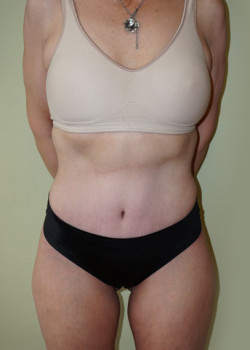 After Image: Tummy Tuck, Liposuction - front