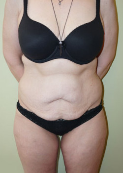 Before Image: Tummy Tuck, Liposuction - front
