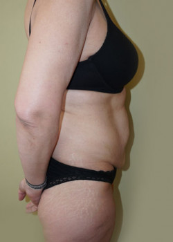 Before Image: Tummy Tuck, Liposuction - other