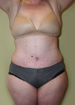 After Image: Tummy Tuck, Liposuction - front