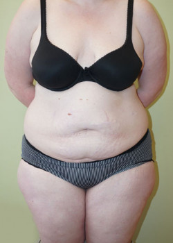 Before Image: Tummy Tuck, Liposuction - front