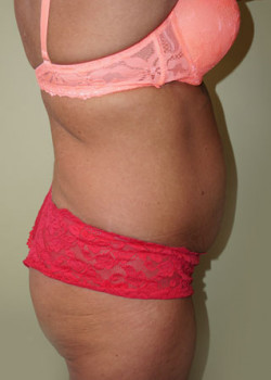 Before Image: Tummy Tuck, Liposuction - other