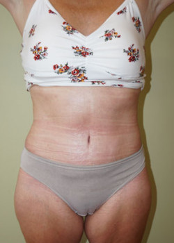 After Image: Tummy Tuck, Liposuction - front