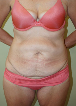 Before Image: Tummy Tuck, Liposuction - front