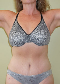 After Image: Tummy Tuck, Liposuction - front