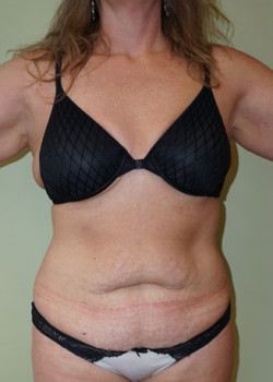 Before Image: Tummy Tuck, Liposuction - front
