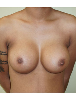 After Image: Breast Augmentation - front