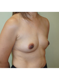 Before Image: Breast Augmentation - right-front-oblique