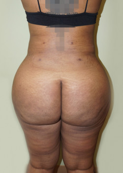 After Image: Brazilian Butt Lift - back